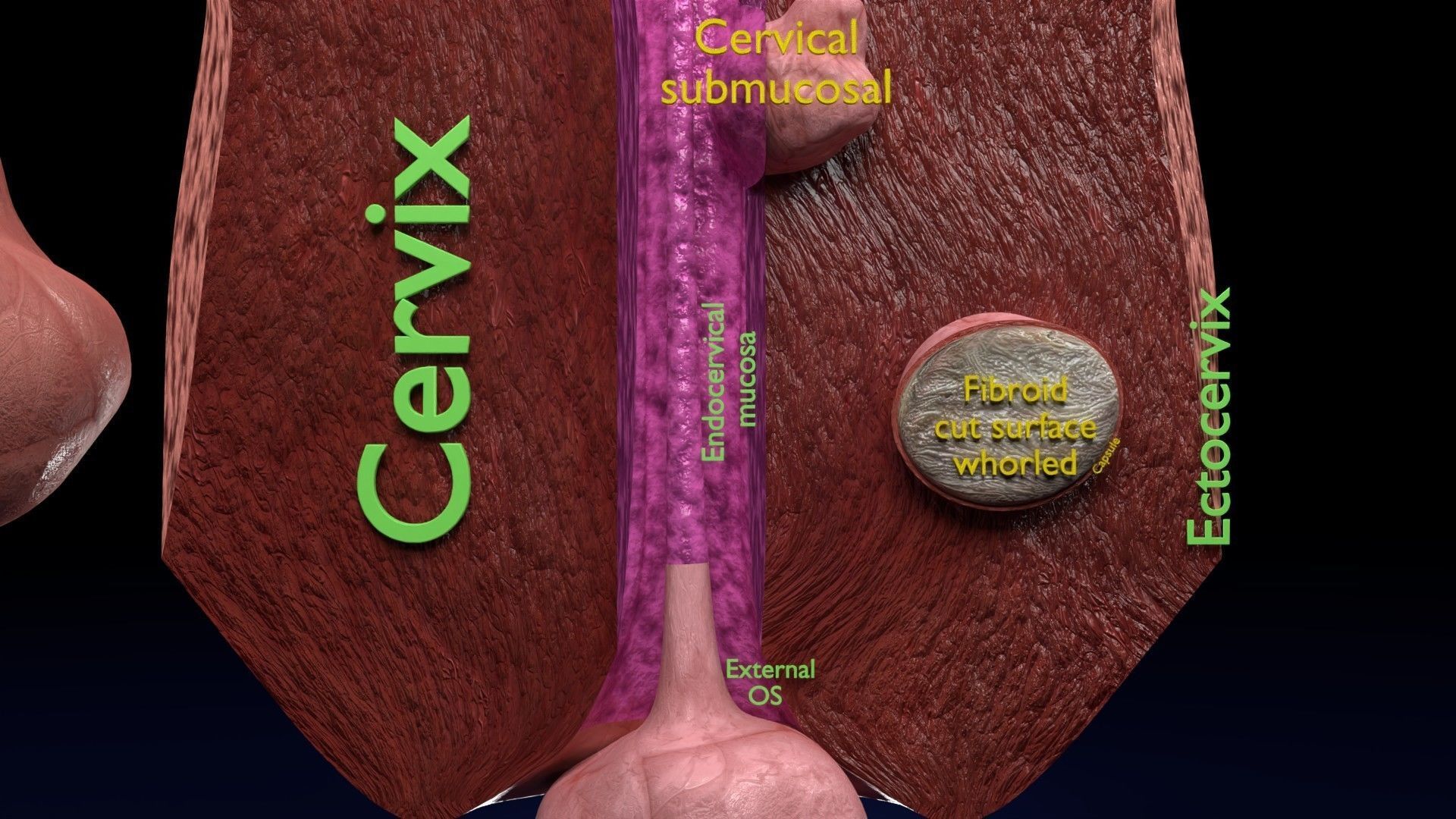 Fibroid Uterus Human female 3D Low-poly 3D model_27