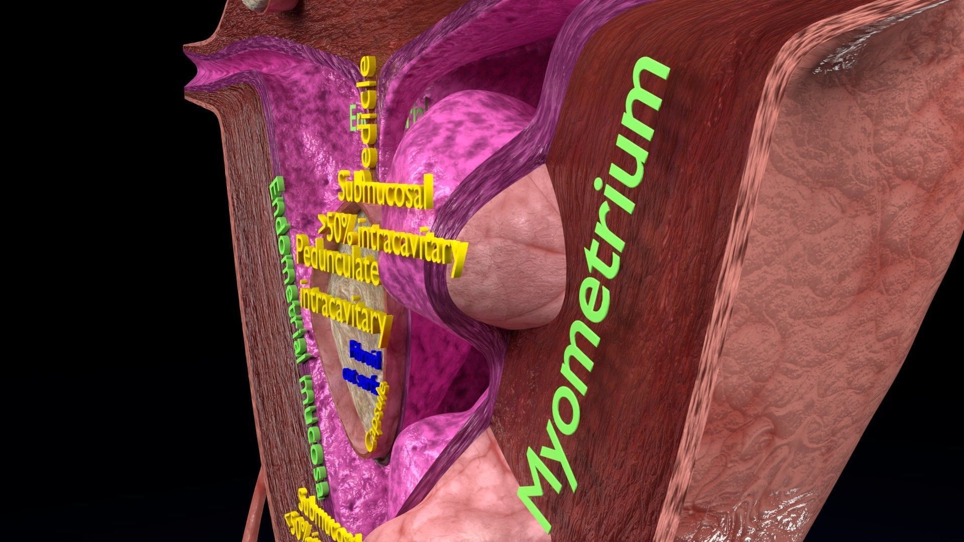 Fibroid Uterus Human female 3D Low-poly 3D model_34