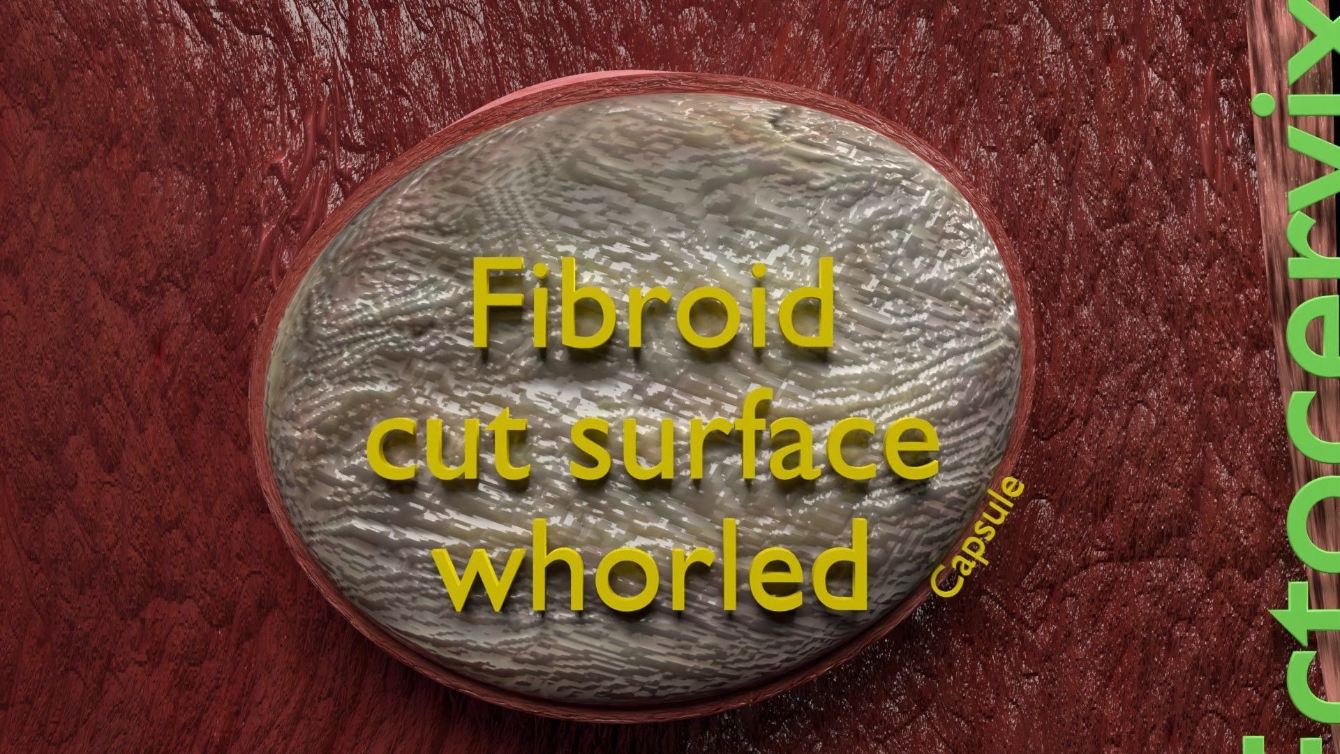 Fibroid Uterus Human female 3D Low-poly 3D model_26