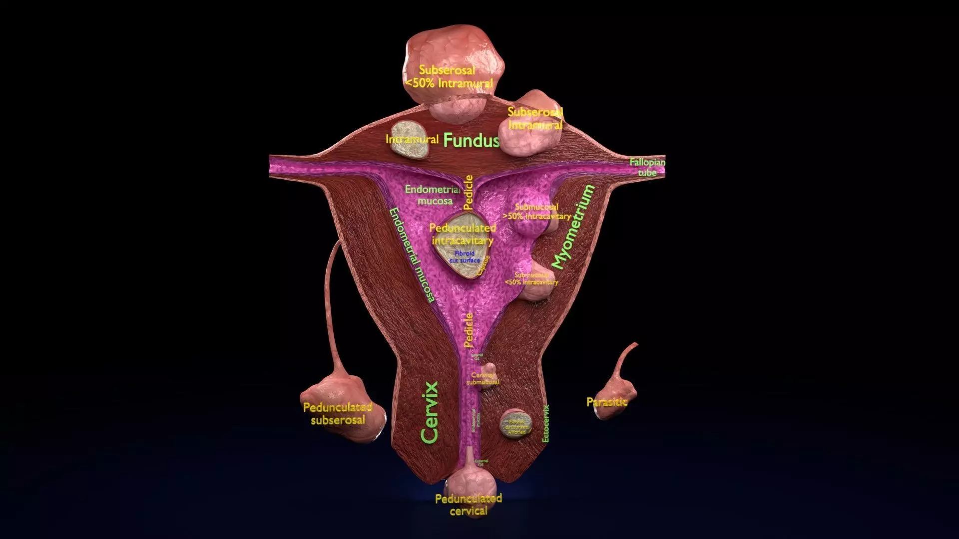 Fibroid Uterus Human female 3D Low-poly 3D model_0