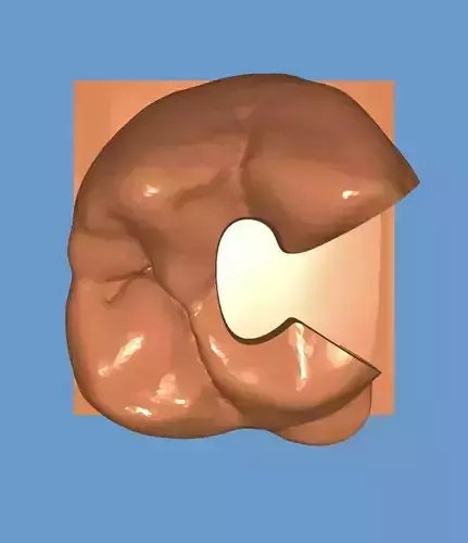 Class ii Amalgam cavity preparation on upper molar 3D print model