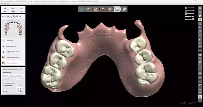 Digital Flexible Partial Denture 3D print model