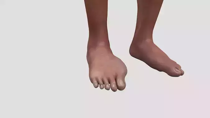 Diabetic foot disease lipocyte adipocyte biology nutrition