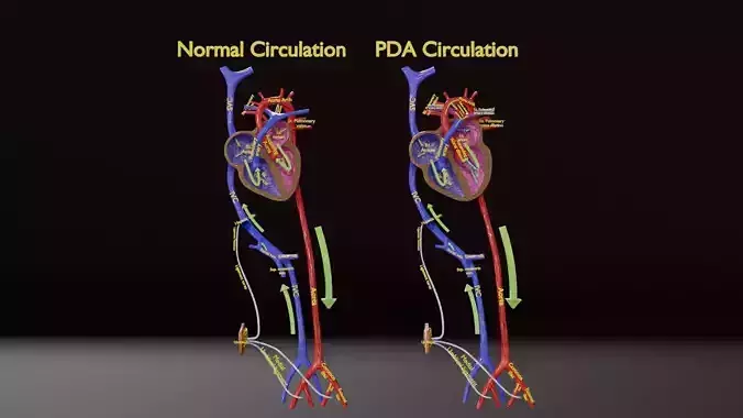 PDA Patent Ductus Arteriosus vs Normal blood circulation Low-poly 3D model