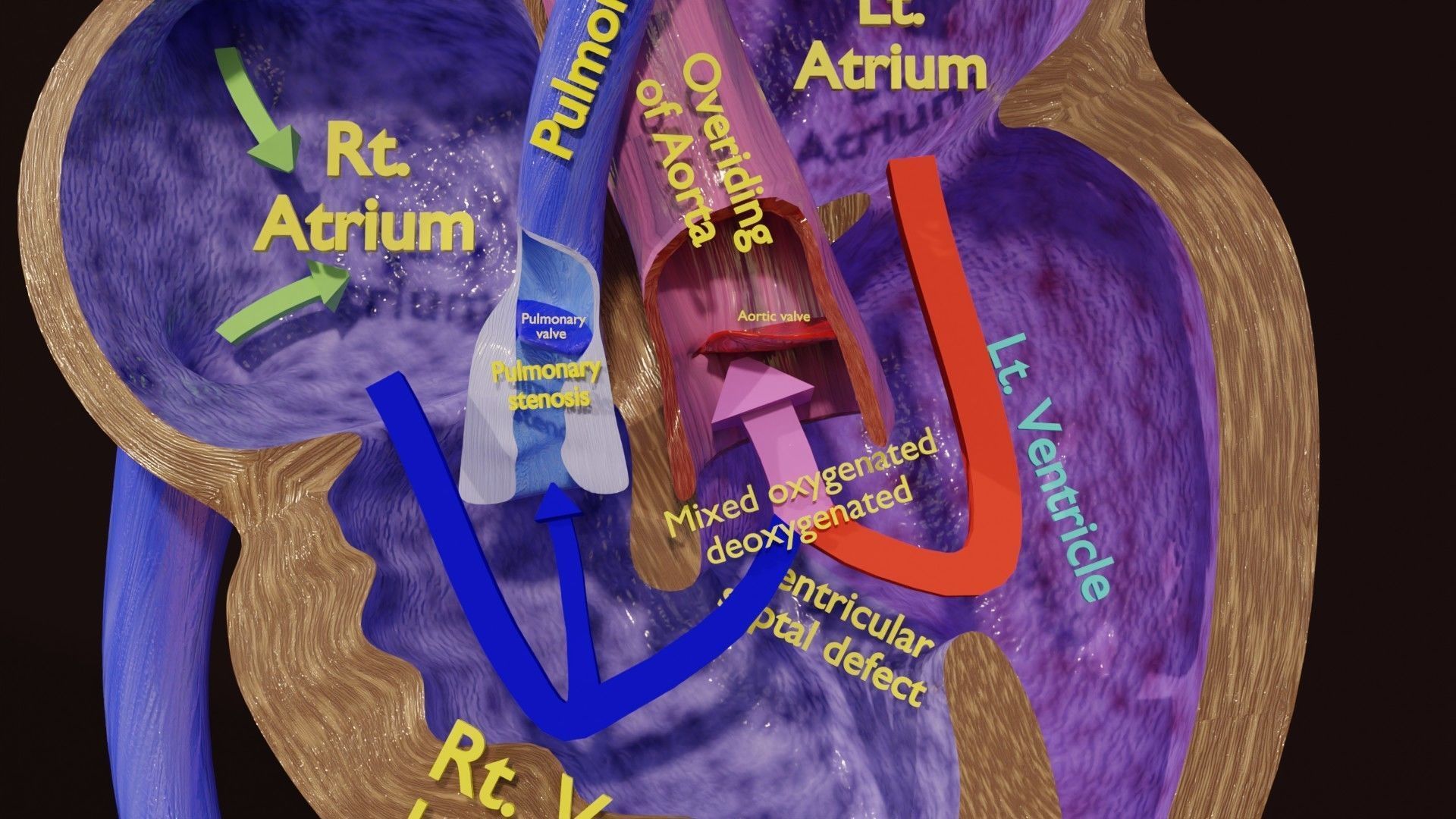TAF Tetralogy of Fallot vs Normal circulation Low-poly 3D model_14