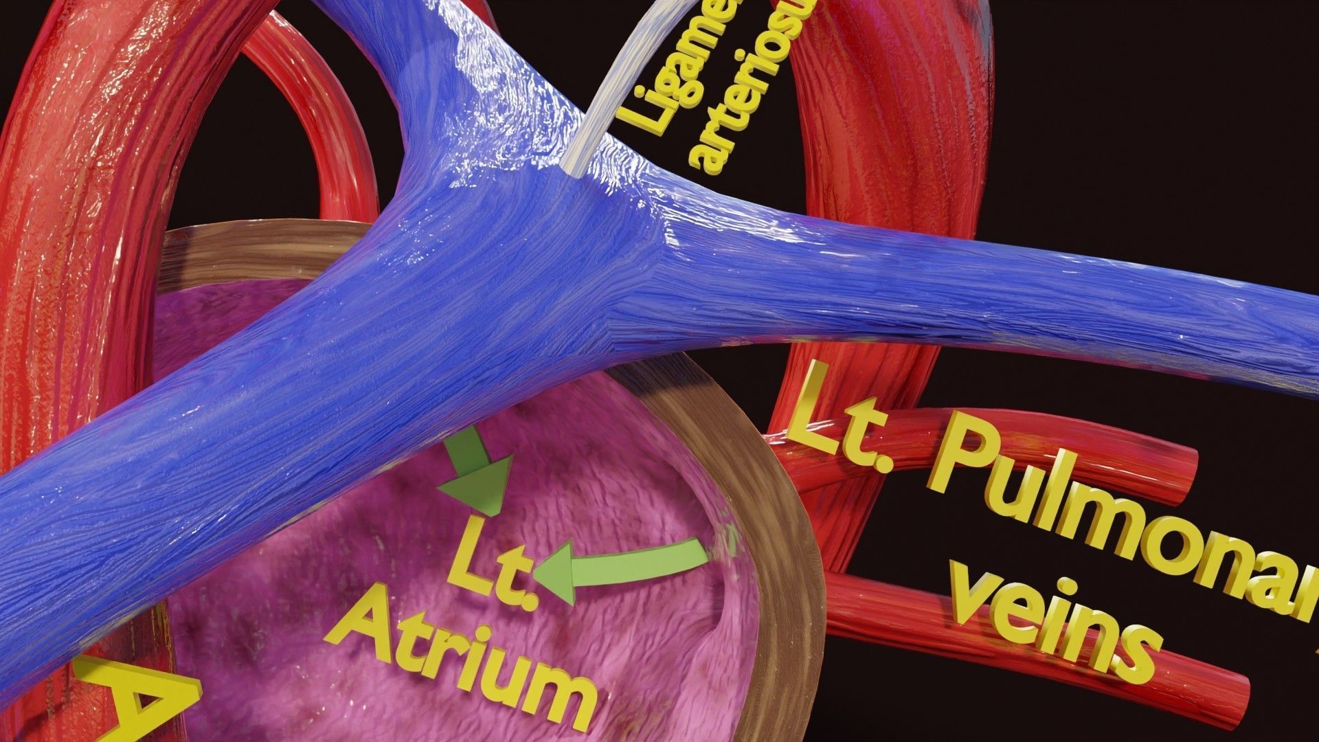 TAF Tetralogy of Fallot vs Normal circulation Low-poly 3D model_31