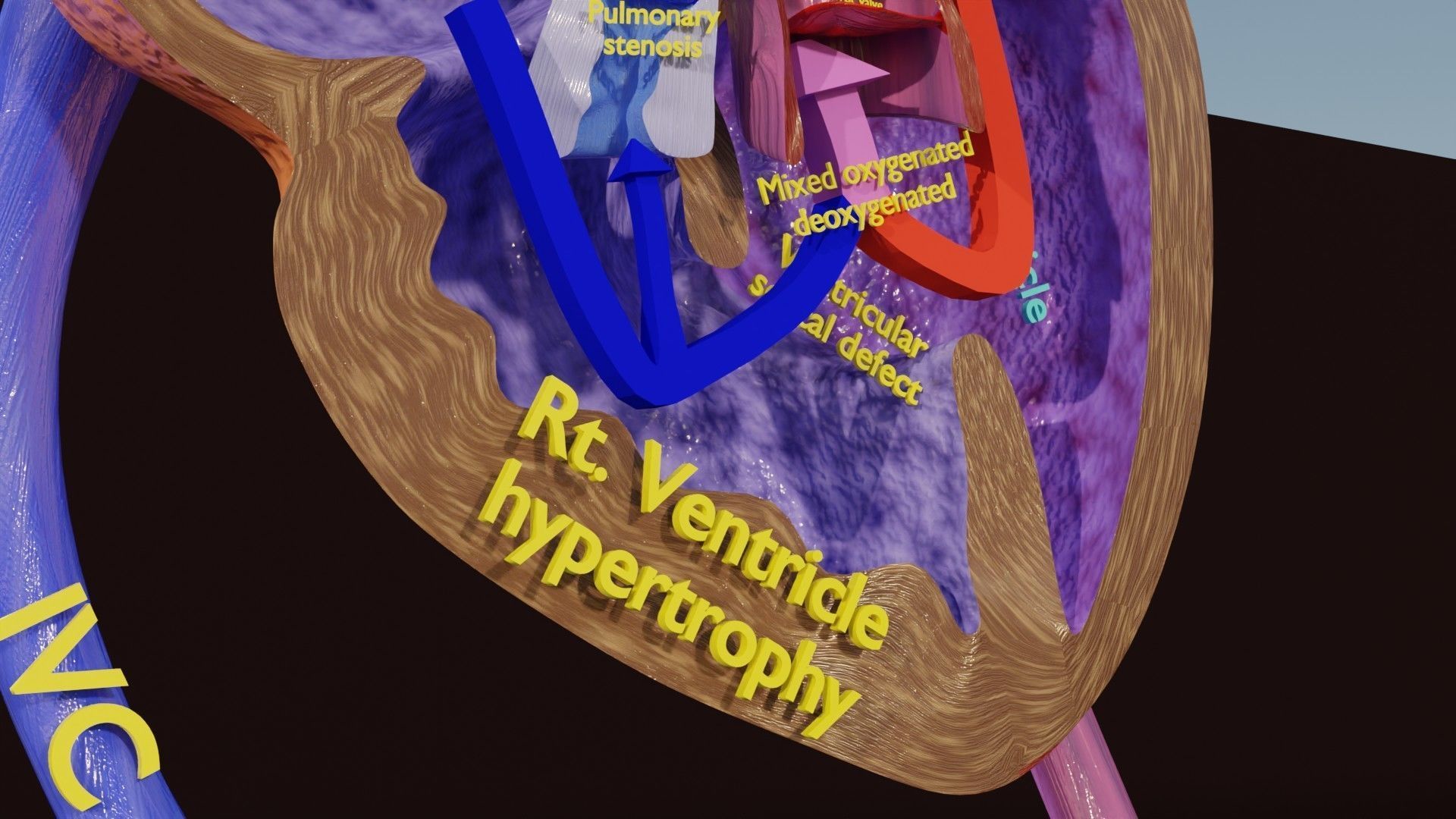 TAF Tetralogy of Fallot vs Normal circulation Low-poly 3D model_20