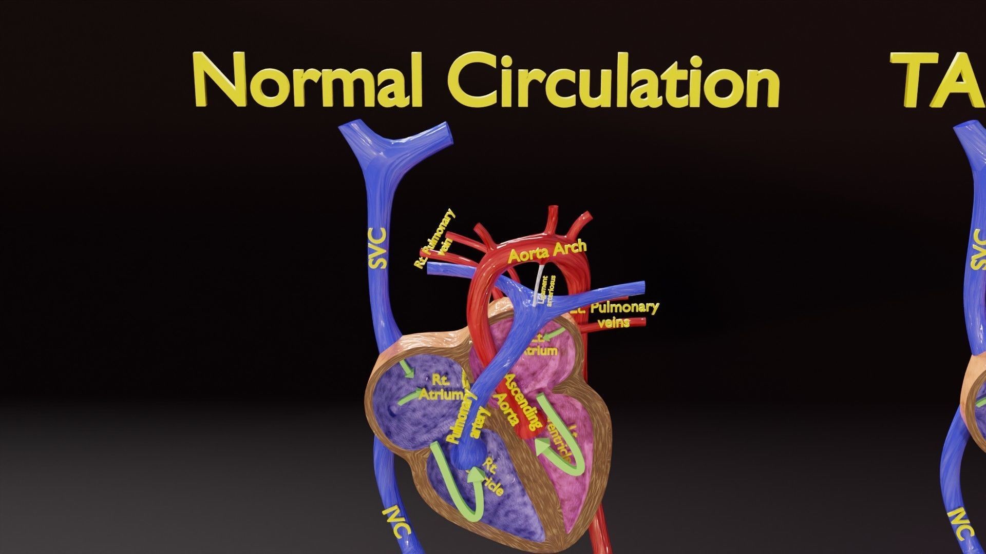 TAF Tetralogy of Fallot vs Normal circulation Low-poly 3D model_24