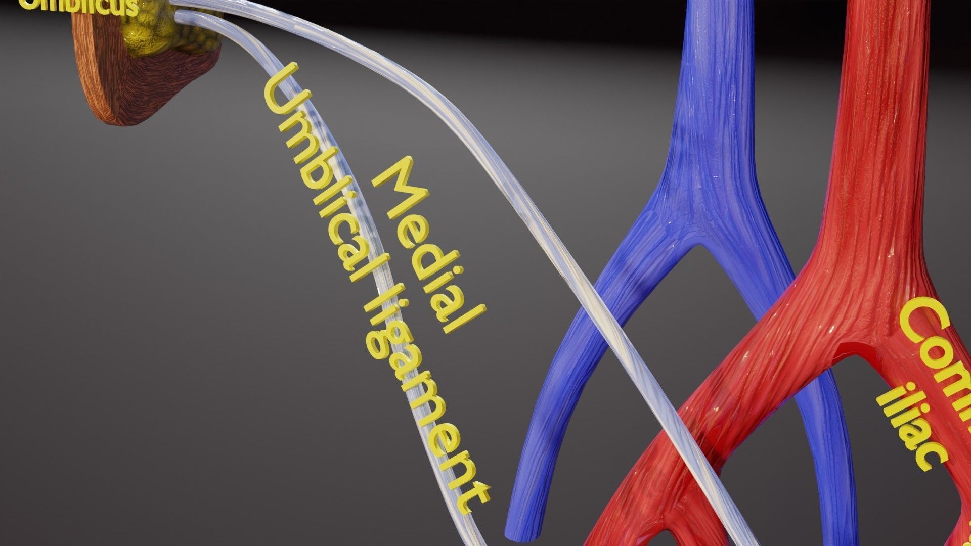 TAF Tetralogy of Fallot vs Normal circulation Low-poly 3D model_35