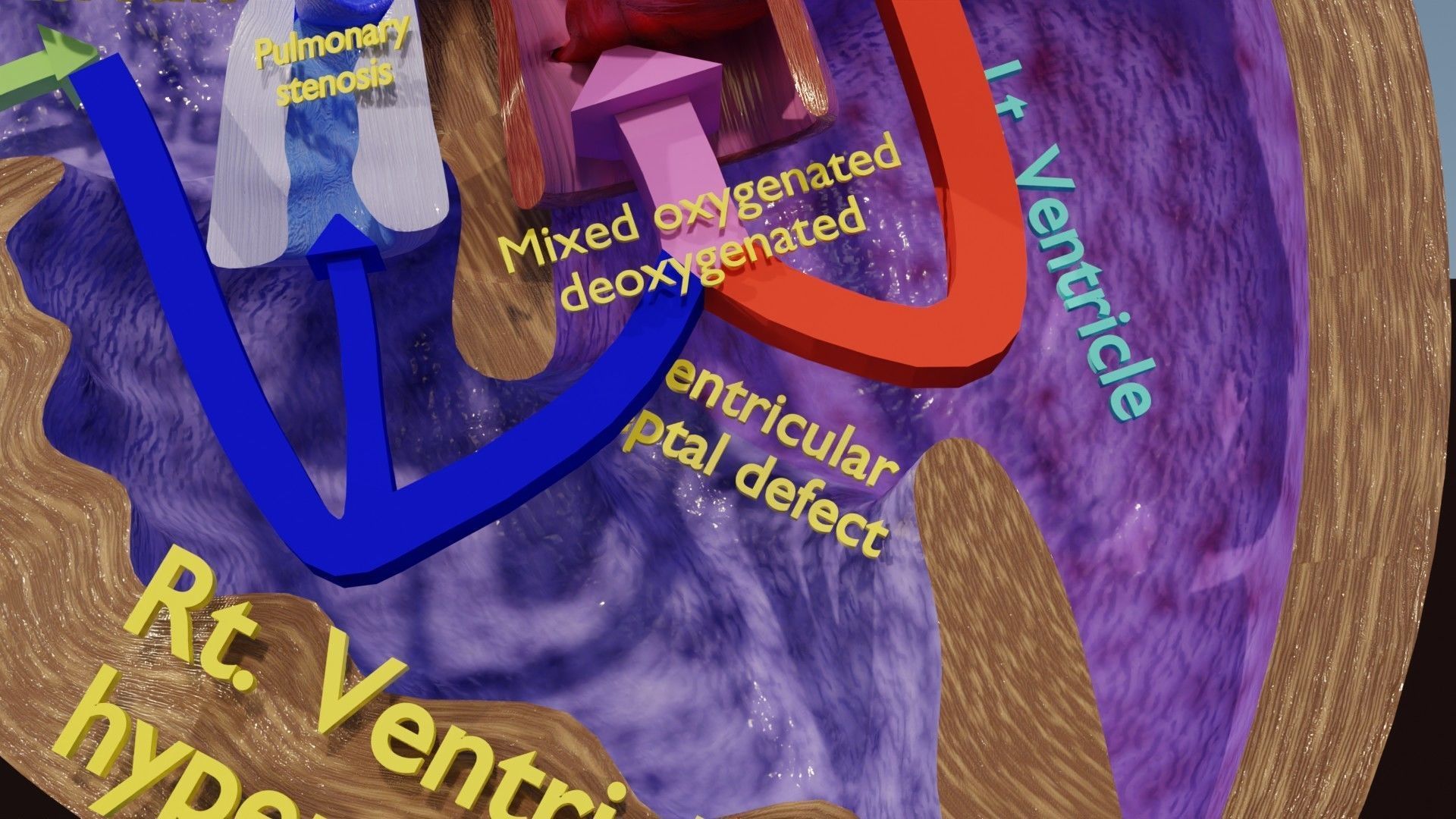 TAF Tetralogy of Fallot vs Normal circulation Low-poly 3D model_17