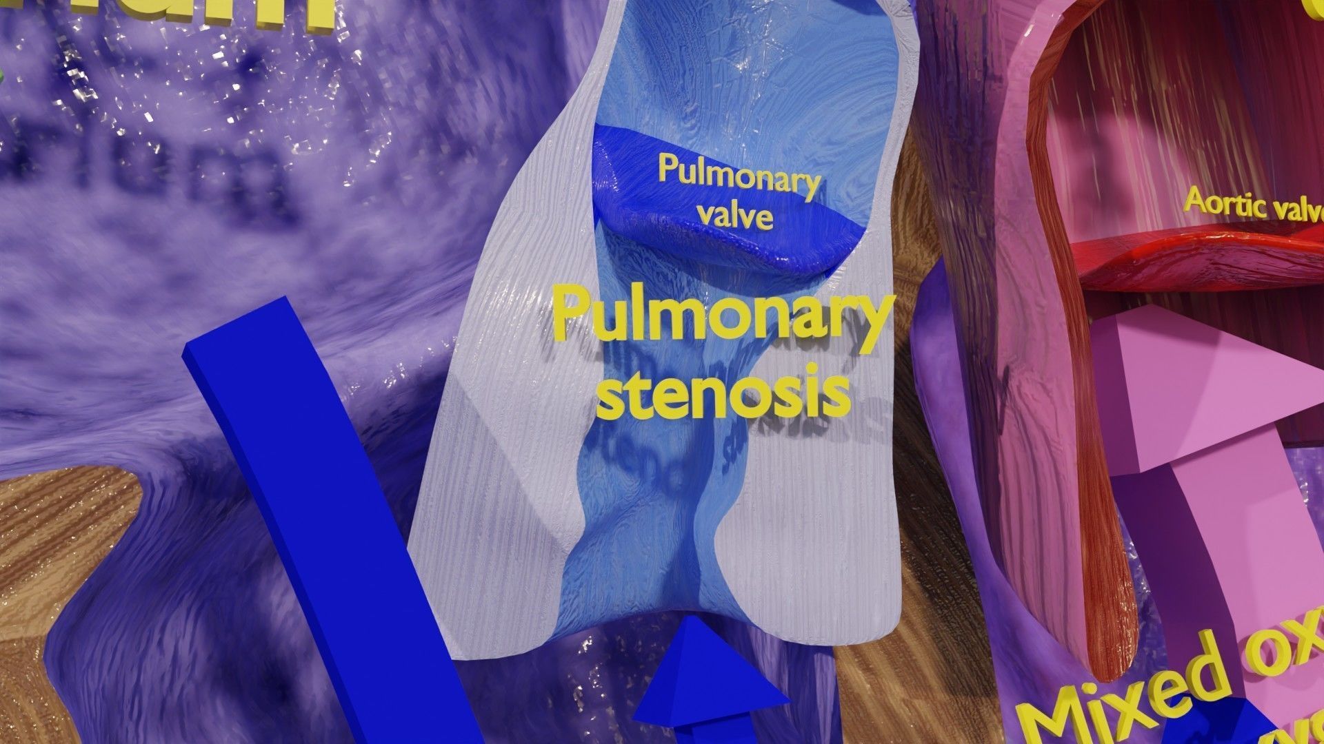 TAF Tetralogy of Fallot vs Normal circulation Low-poly 3D model_18