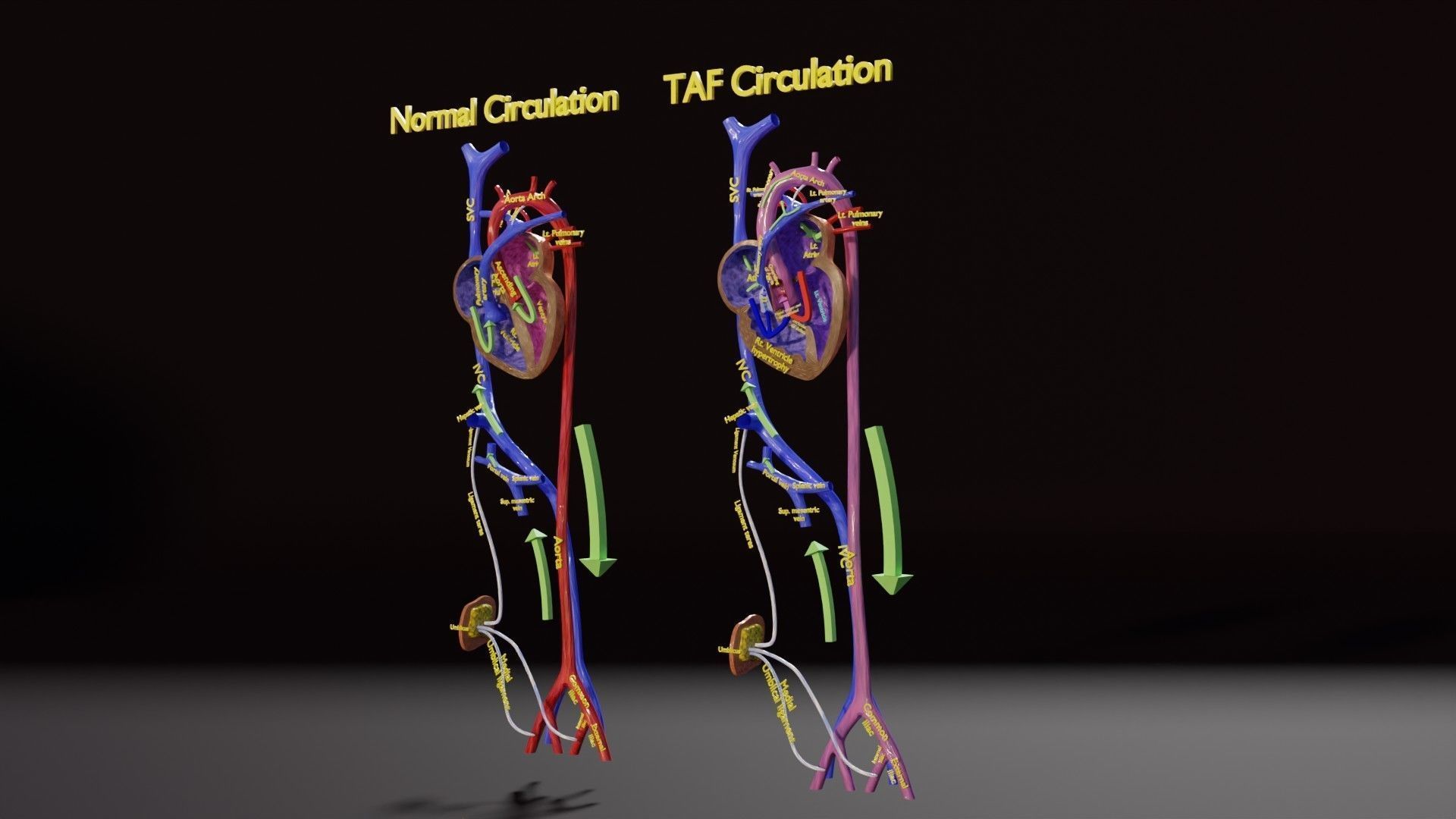 TAF Tetralogy of Fallot vs Normal circulation Low-poly 3D model_4