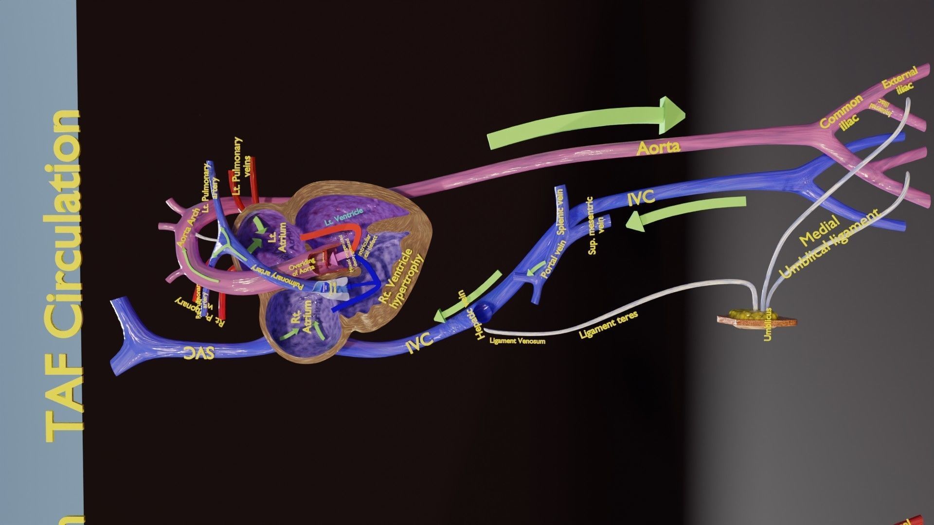 TAF Tetralogy of Fallot vs Normal circulation Low-poly 3D model_10