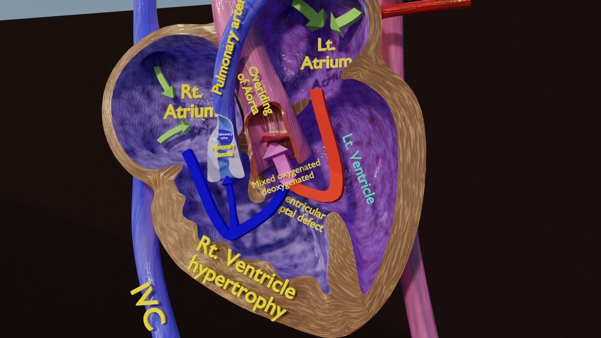 TAF Tetralogy of Fallot vs Normal circulation Low-poly 3D model_23
