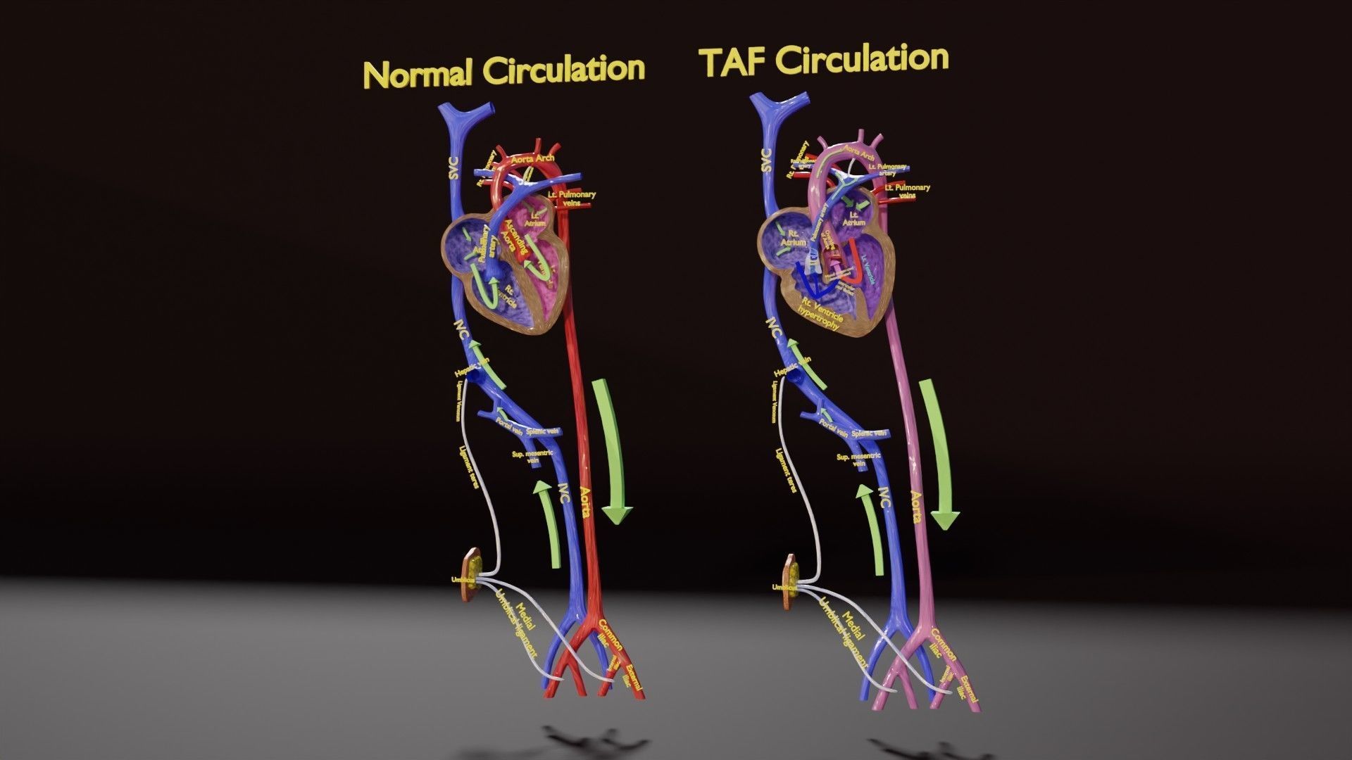 TAF Tetralogy of Fallot vs Normal circulation Low-poly 3D model_2