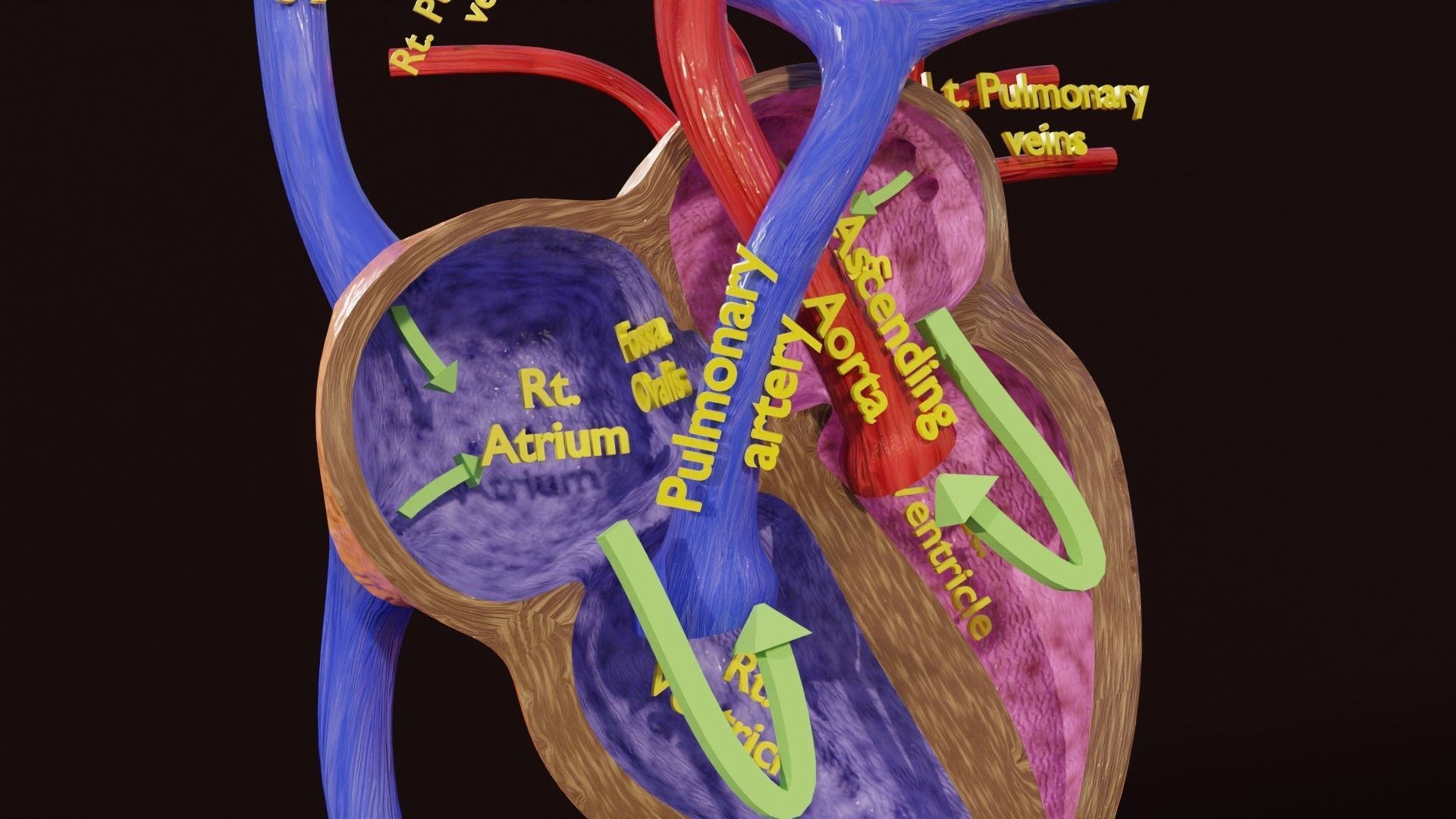 TAF Tetralogy of Fallot vs Normal circulation Low-poly 3D model_30
