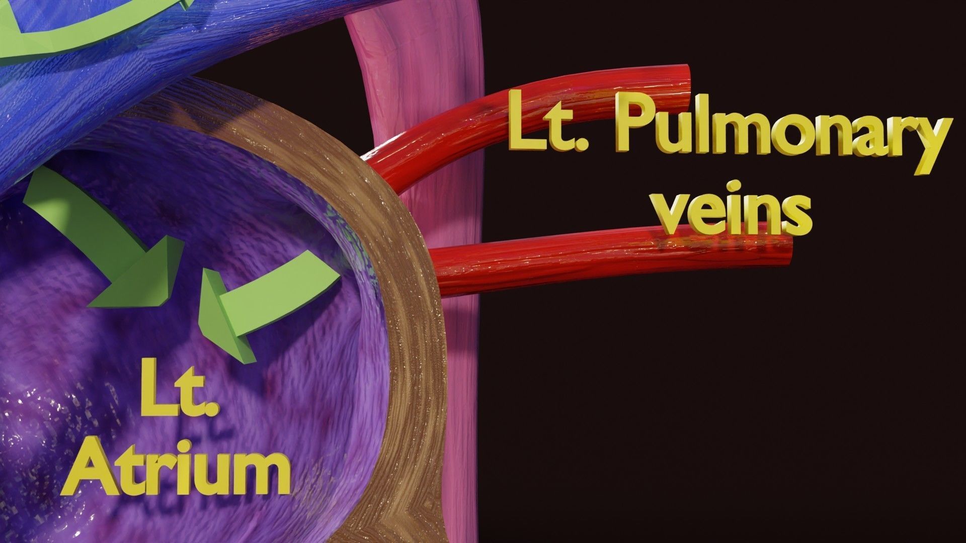 TAF Tetralogy of Fallot vs Normal circulation Low-poly 3D model_12