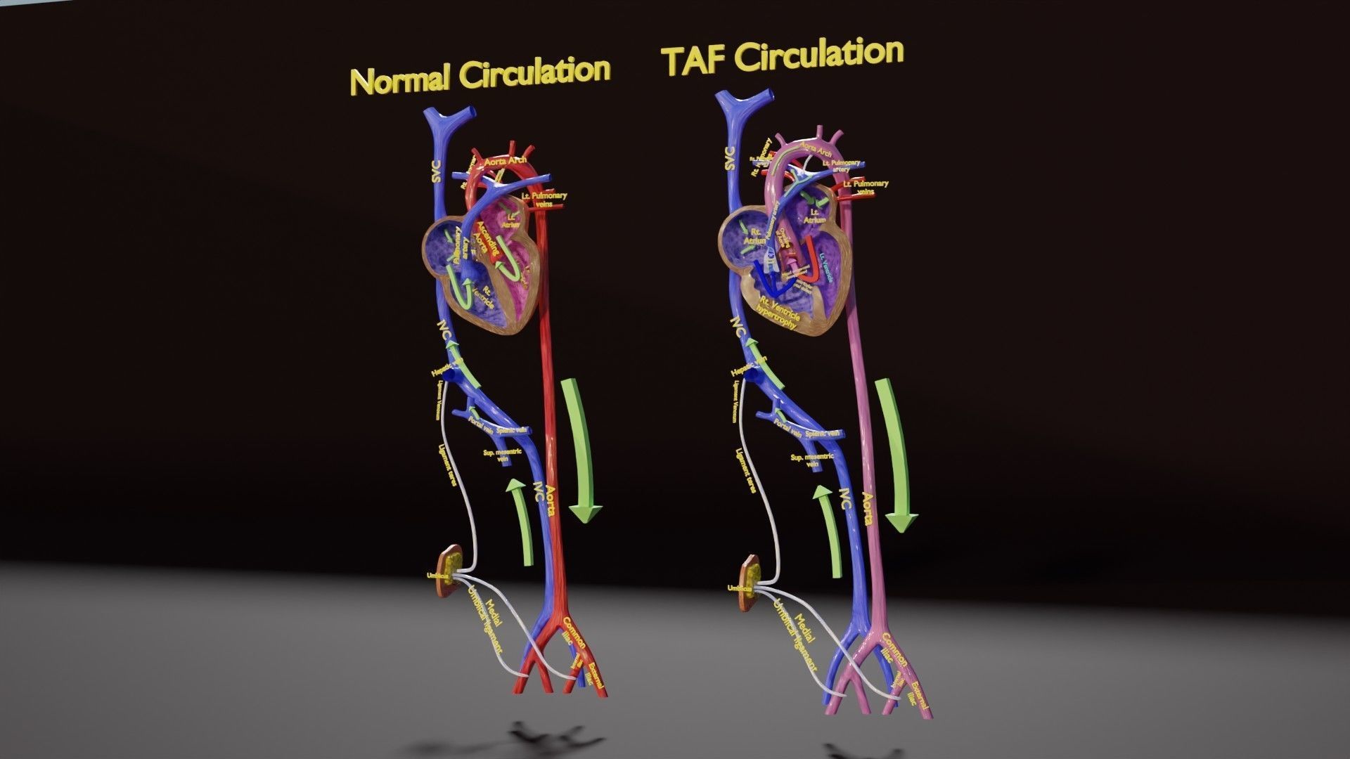 TAF Tetralogy of Fallot vs Normal circulation Low-poly 3D model_3
