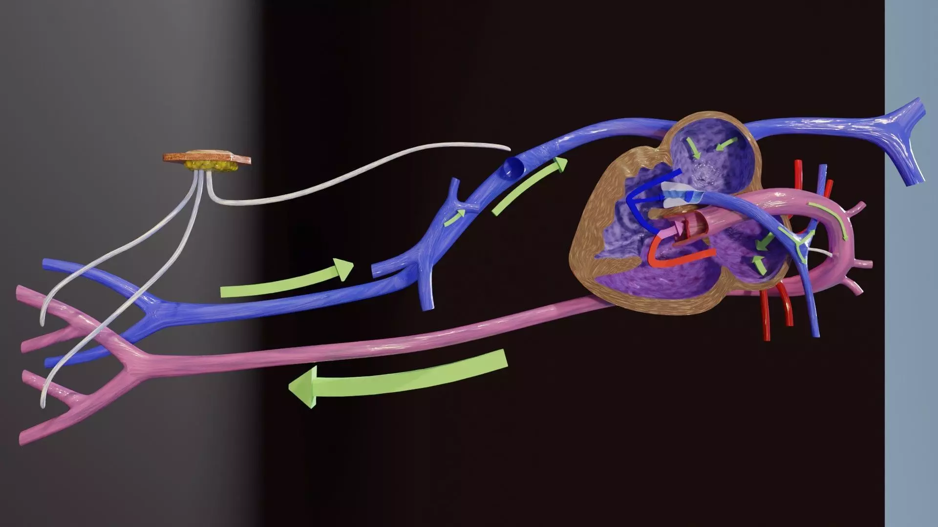TAF Tetralogy of Fallot vs Normal circulation Low-poly 3D model_0