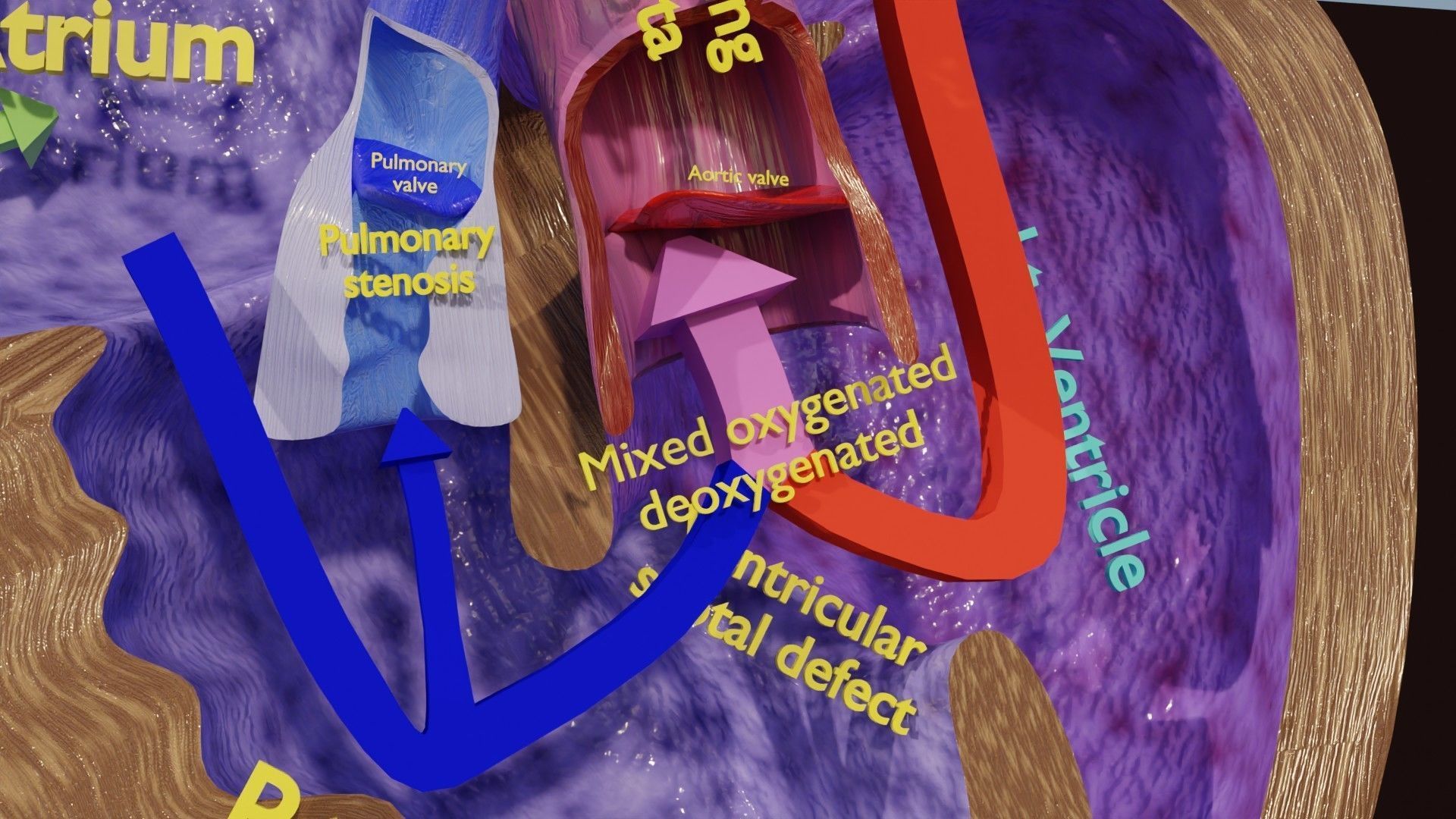 TAF Tetralogy of Fallot vs Normal circulation Low-poly 3D model_21