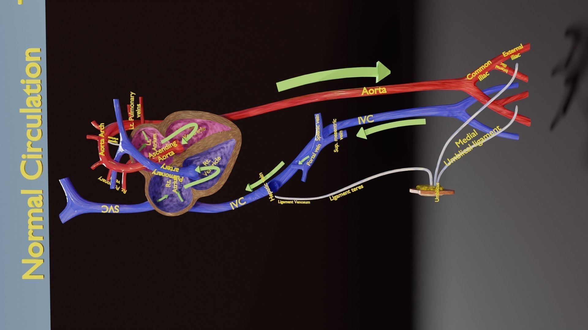 TAF Tetralogy of Fallot vs Normal circulation Low-poly 3D model_38