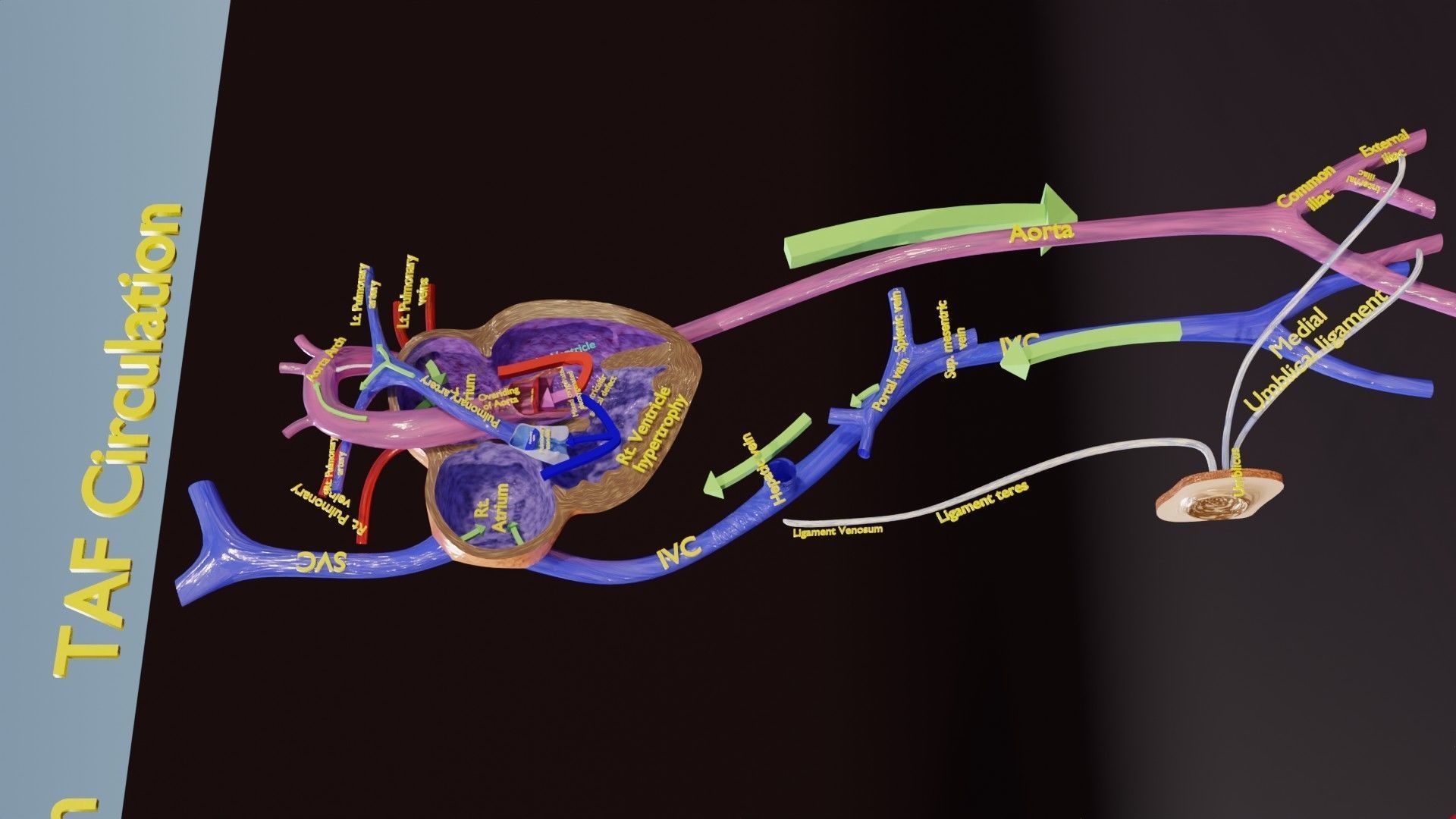 TAF Tetralogy of Fallot vs Normal circulation Low-poly 3D model_9
