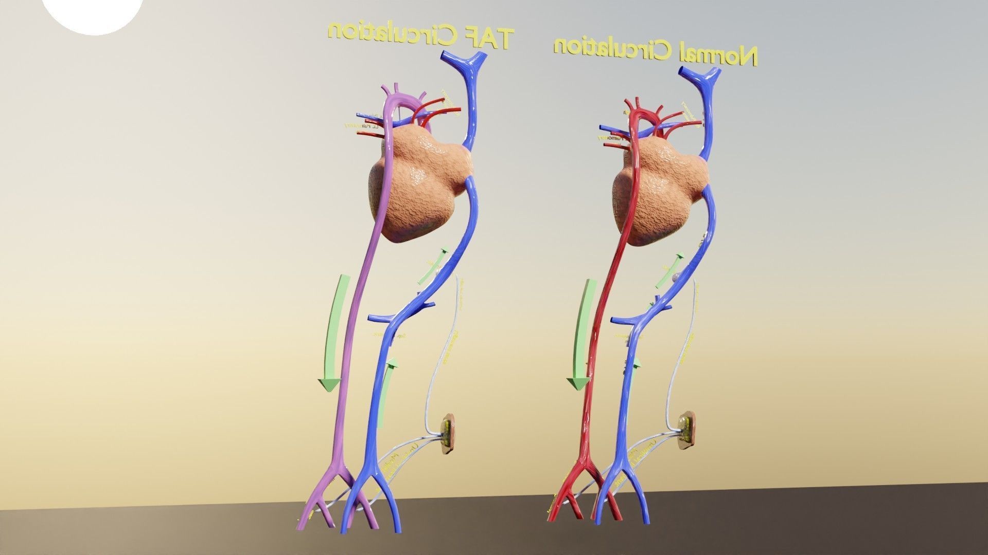 TAF Tetralogy of Fallot vs Normal circulation Low-poly 3D model_39