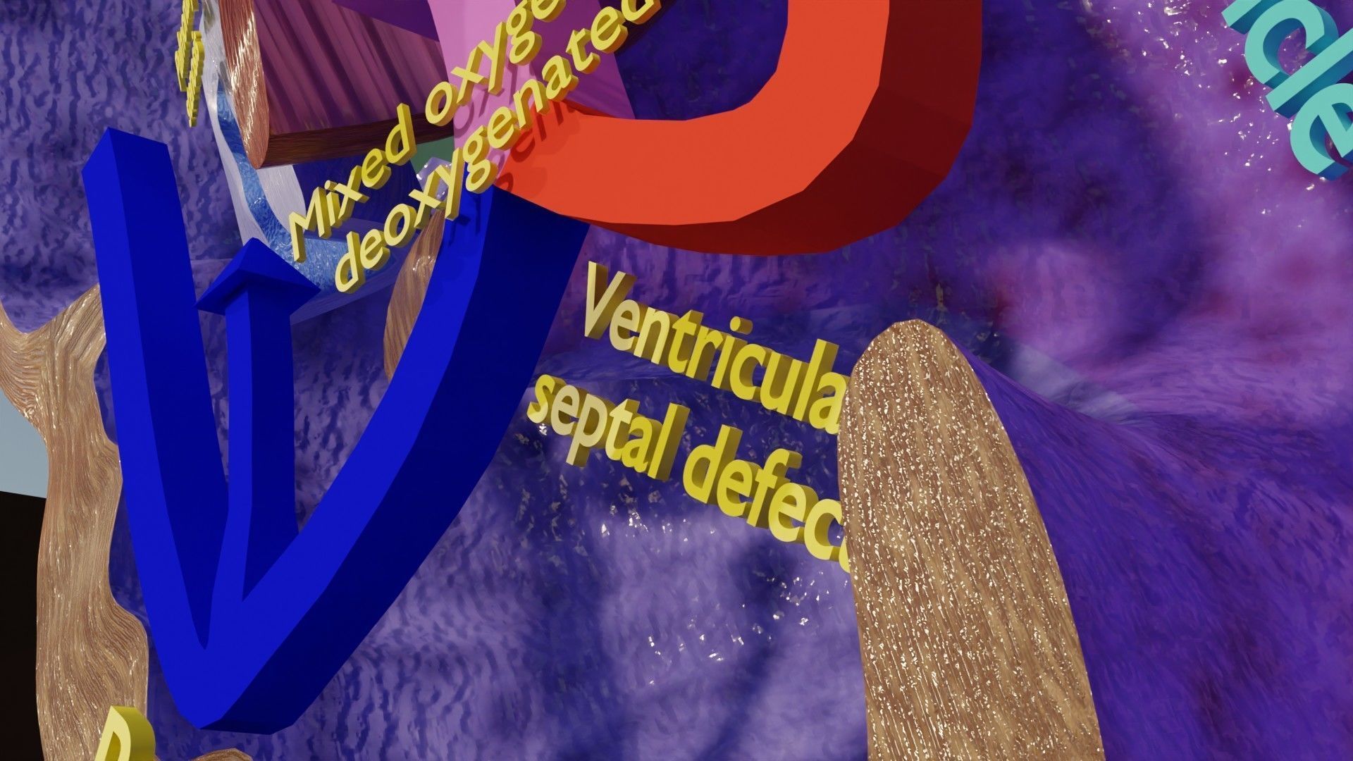 TAF Tetralogy of Fallot vs Normal circulation Low-poly 3D model_15