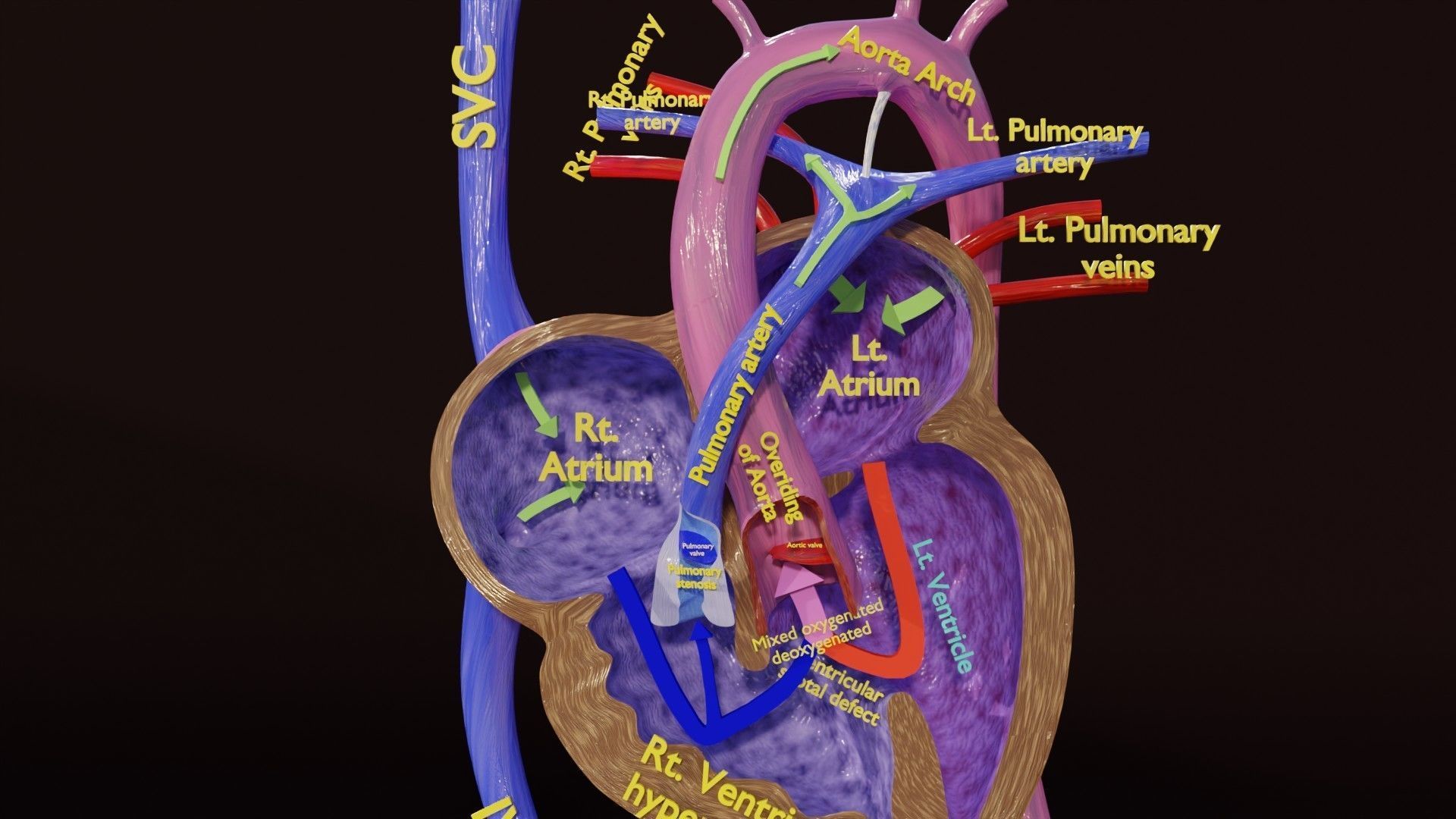 TAF Tetralogy of Fallot vs Normal circulation Low-poly 3D model_11
