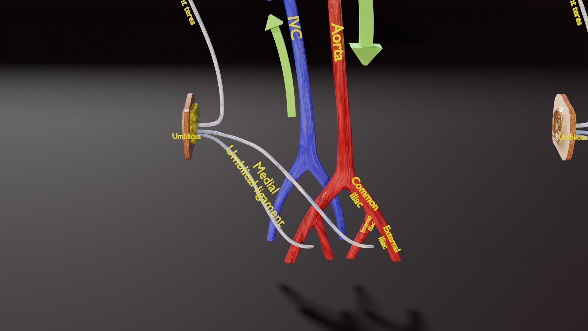 TAF Tetralogy of Fallot vs Normal circulation Low-poly 3D model_26