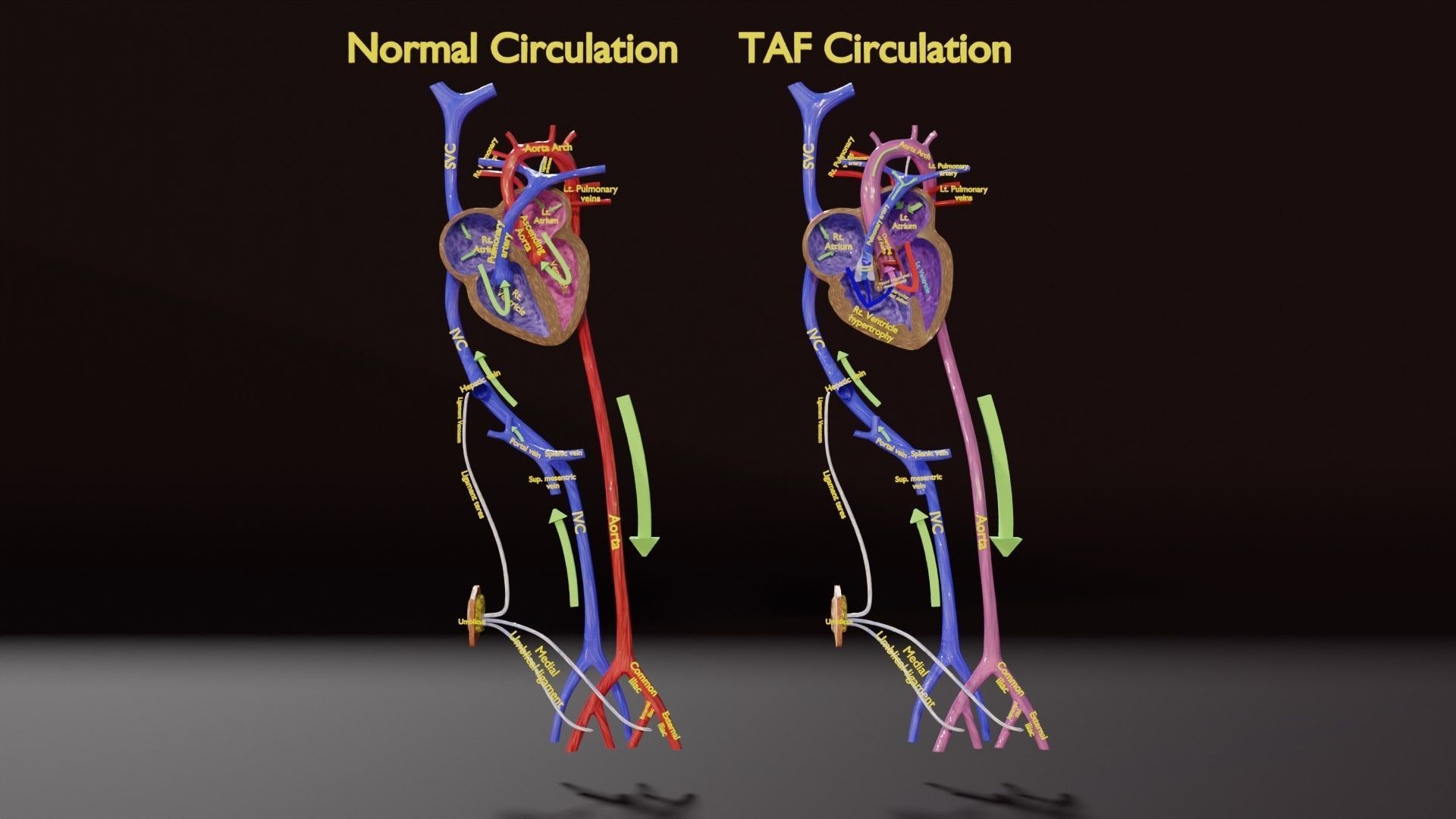 TAF Tetralogy of Fallot vs Normal circulation Low-poly 3D model_1