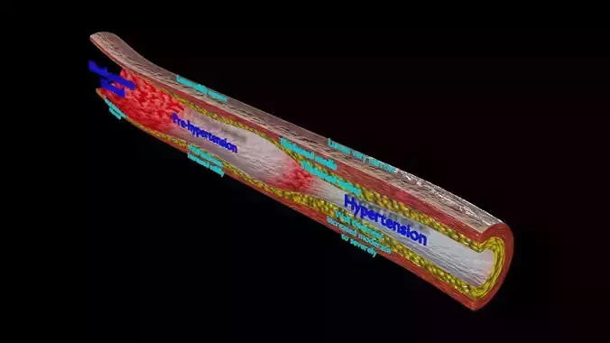 Hypertension blood vessel artery structural change Low-poly 3D model