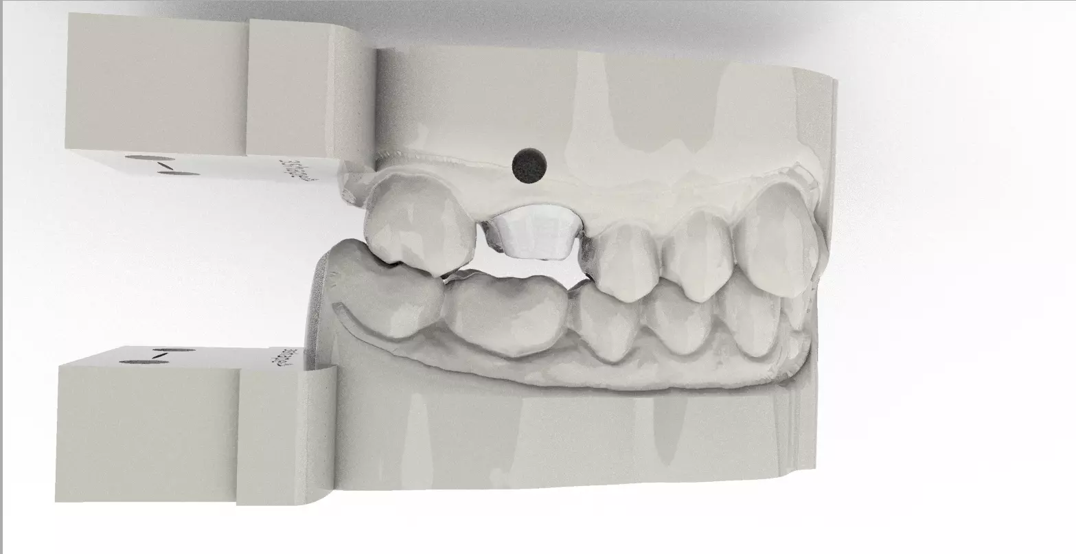 Digital Quadrant Model with iTero Articulator Interfaces 3D print model