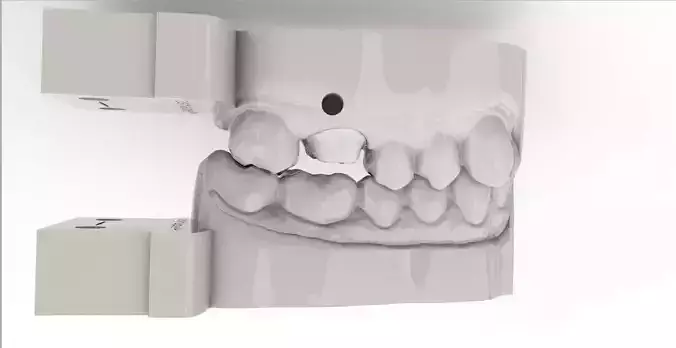 Digital Quadrant Model with iTero Articulator Interfaces 3D print model