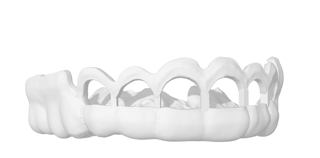 Digital Gingivectomy Guide 3D print model_5