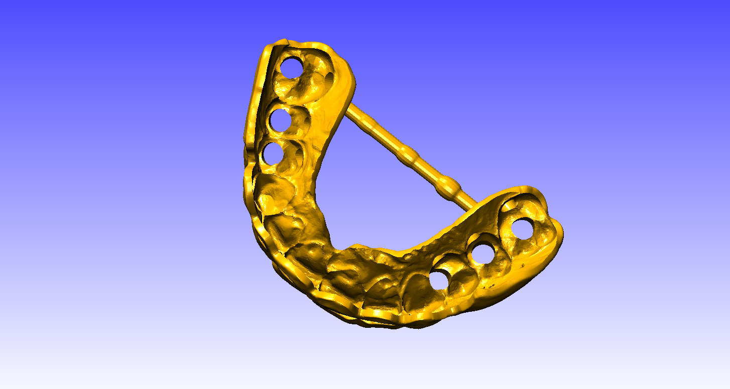 Digital Gingivectomy Guide 3D print model_4