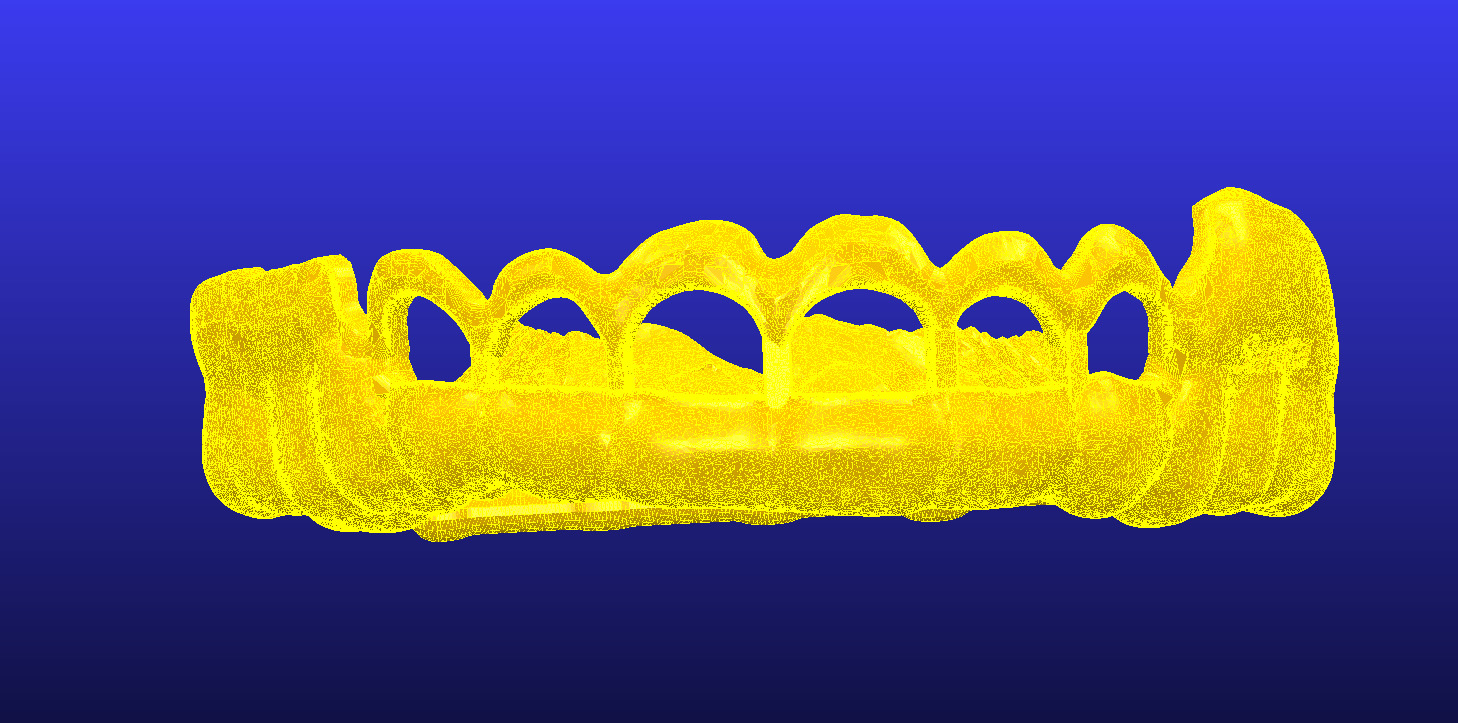 Digital Gingivectomy Guide 3D print model_3