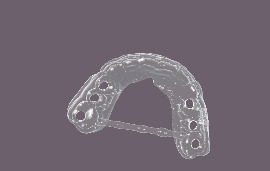 Digital Gingivectomy Guide 3D print model_7