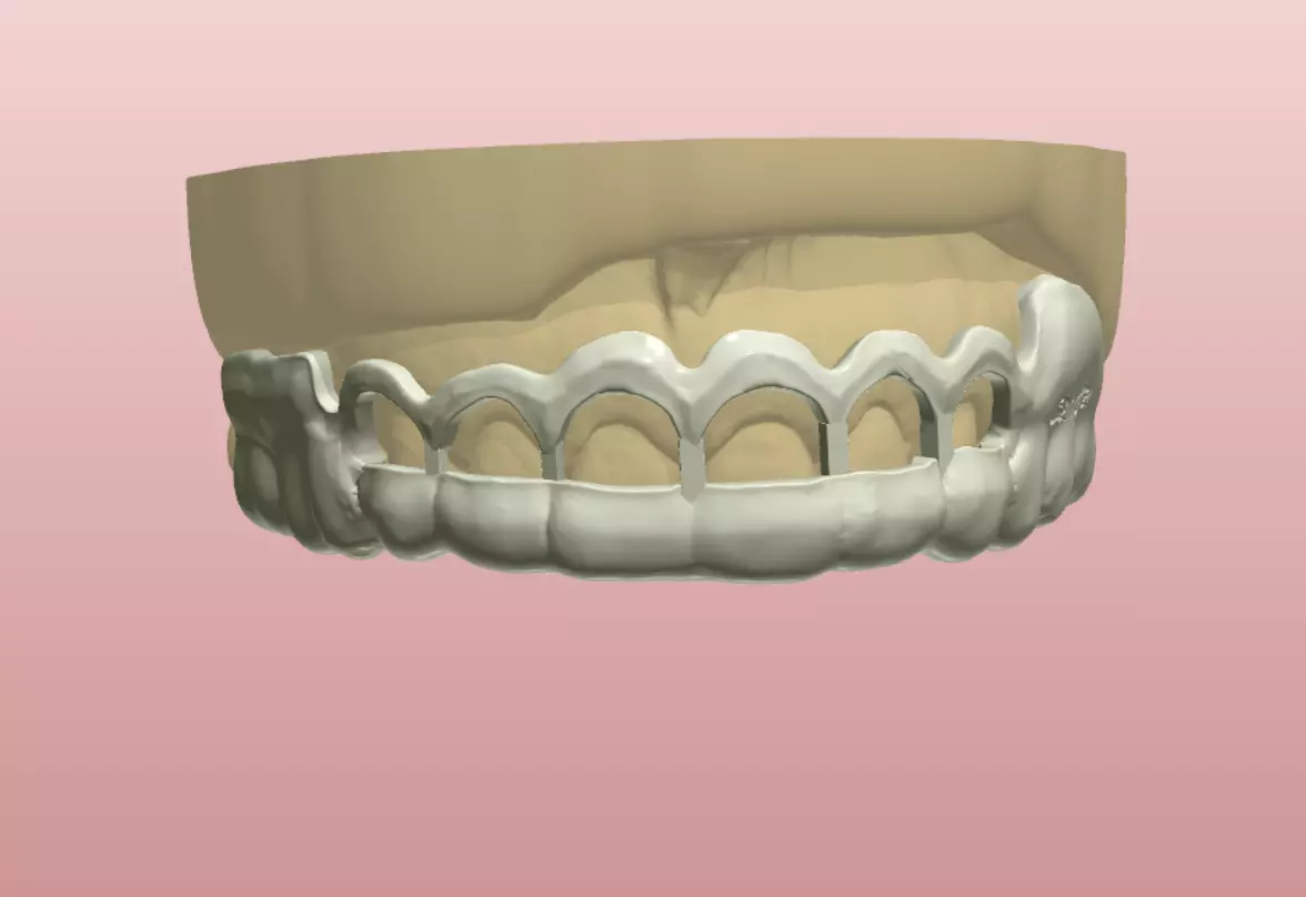 Digital Gingivectomy Guide 3D print model_0