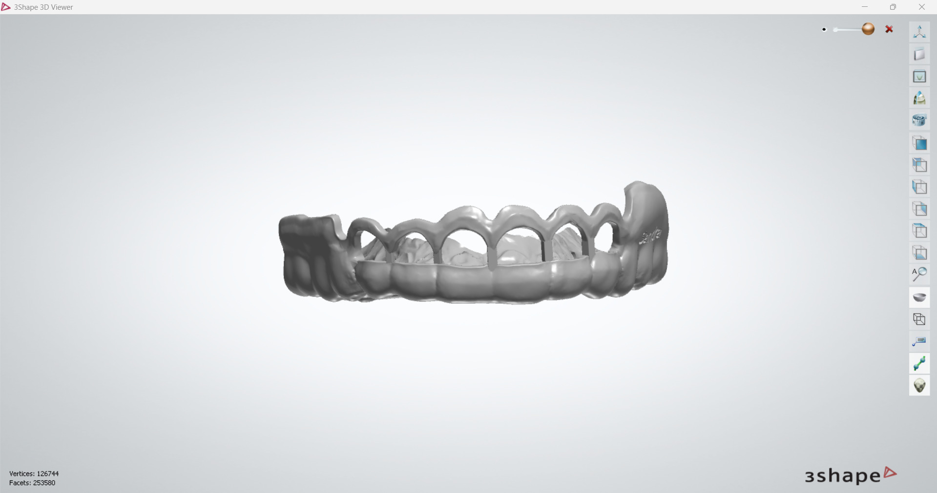 Digital Gingivectomy Guide 3D print model_2