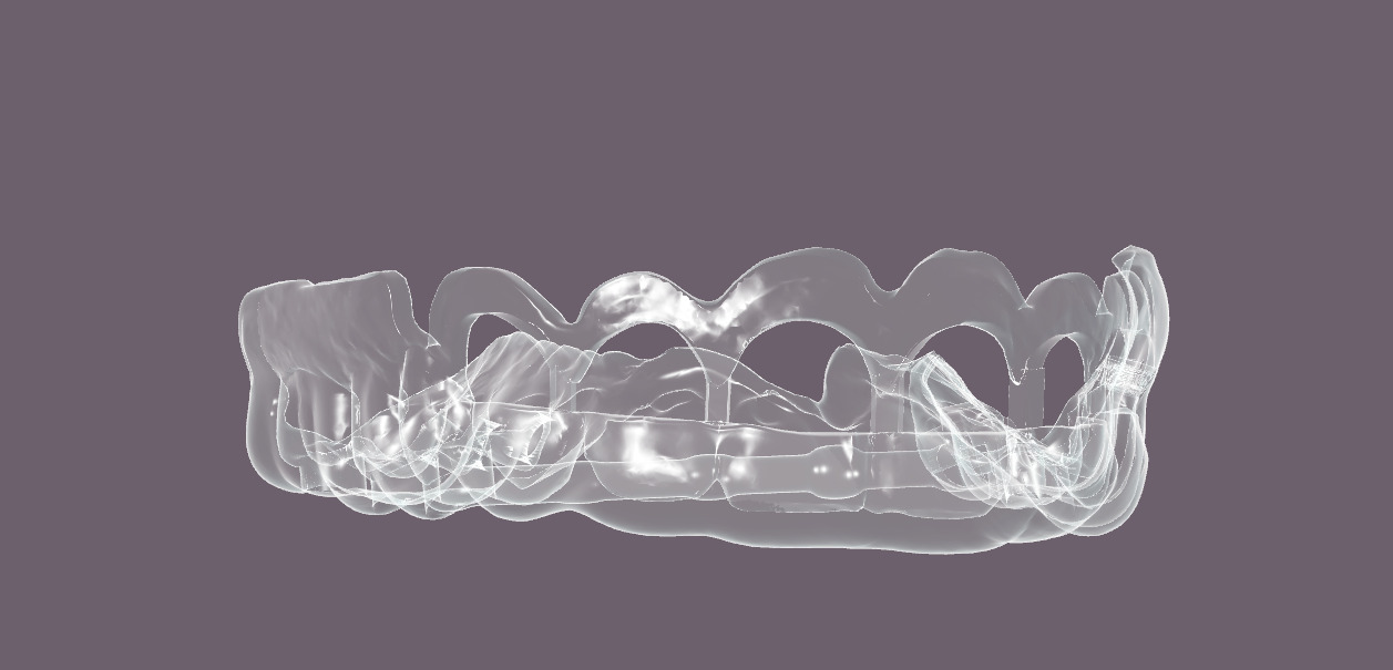 Digital Gingivectomy Guide 3D print model_6