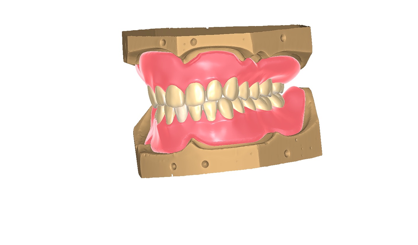 Digital exocad Complete Dentures  3D print model_2
