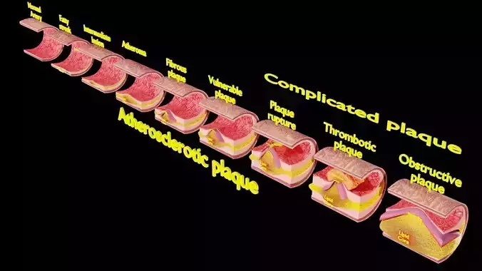 Artery Atherosclerosis plaque and consequences  Low-poly 3D model