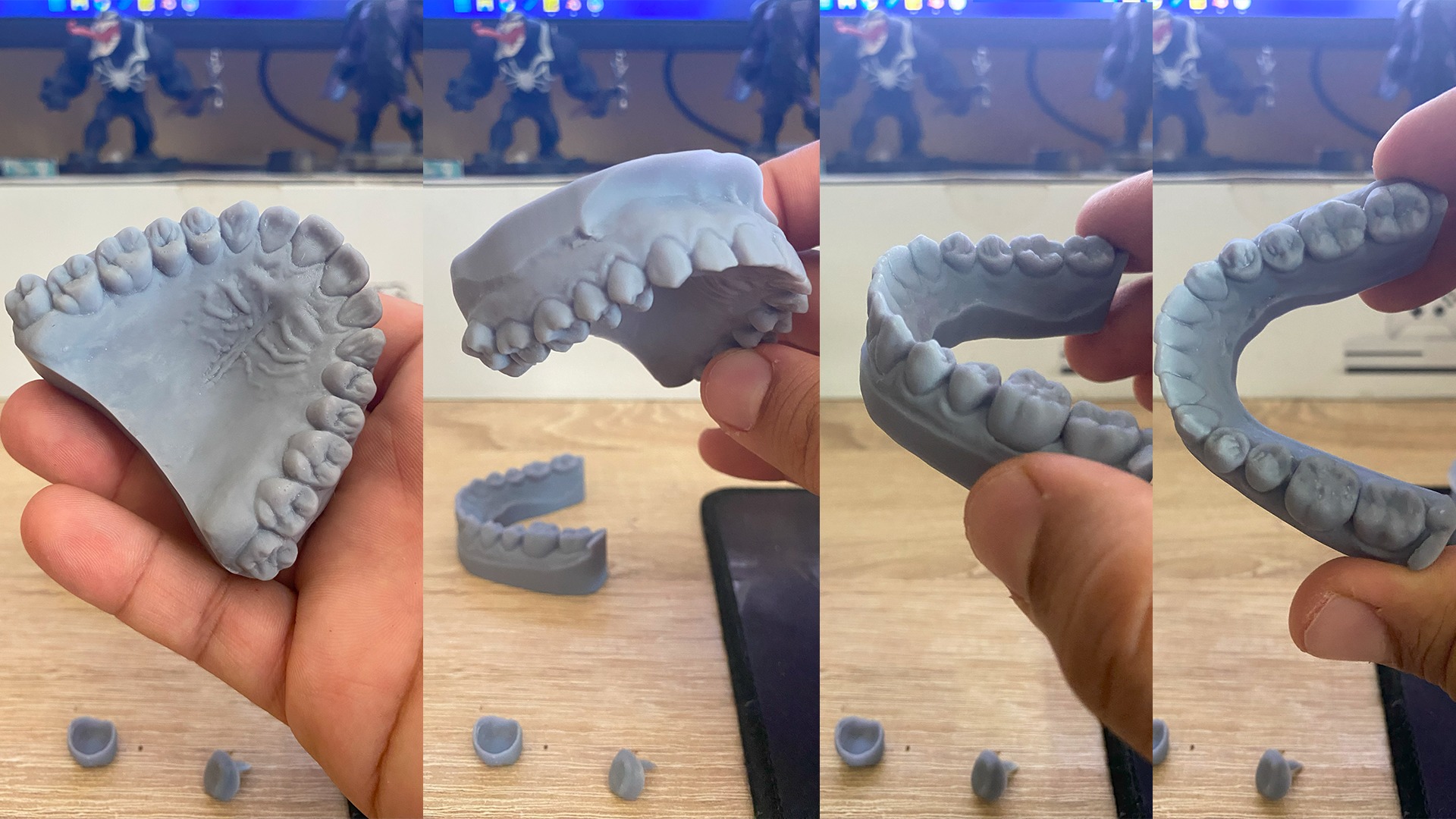 Human Dental Anatomy Mouth with Detached Crown and Inlay  3D print model_2