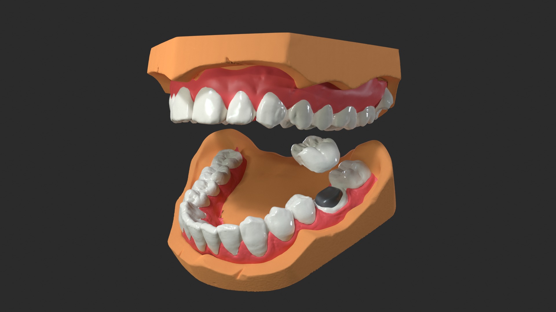 Human Dental Anatomy Mouth with Detached Crown and Inlay  3D print model_4