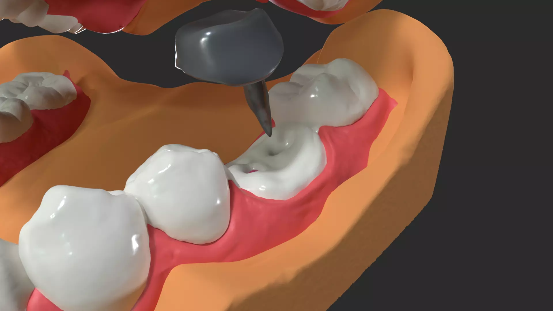 Human Dental Anatomy Mouth with Detached Crown and Inlay  3D print model_0