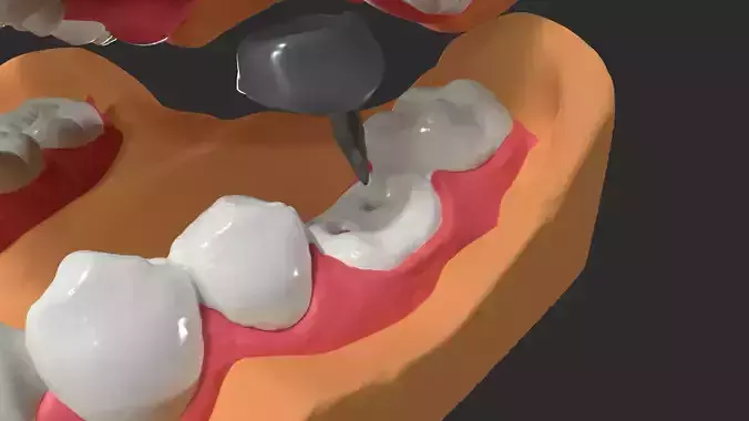 Human Dental Anatomy Mouth with Detached Crown and Inlay  3D print model