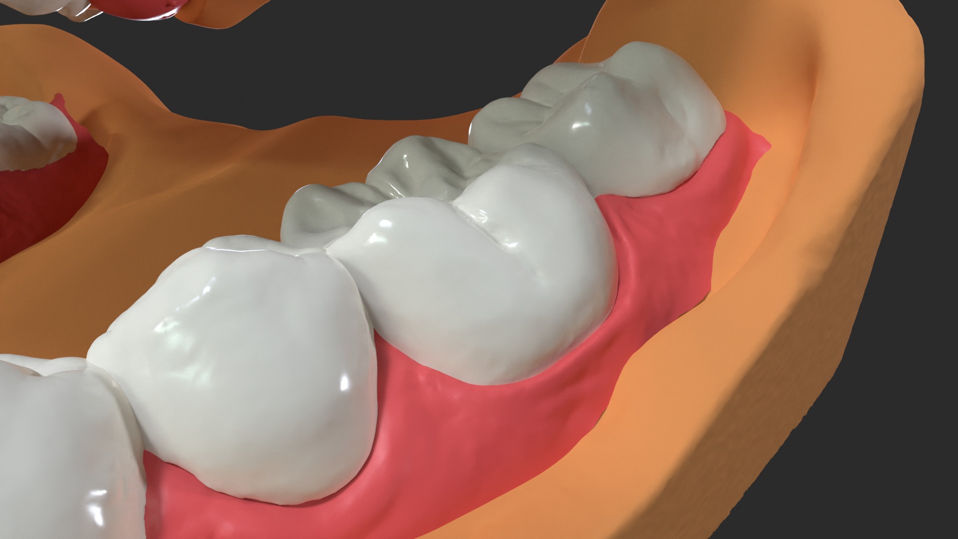 Human Dental Anatomy Mouth with Detached Crown and Inlay  3D print model_8