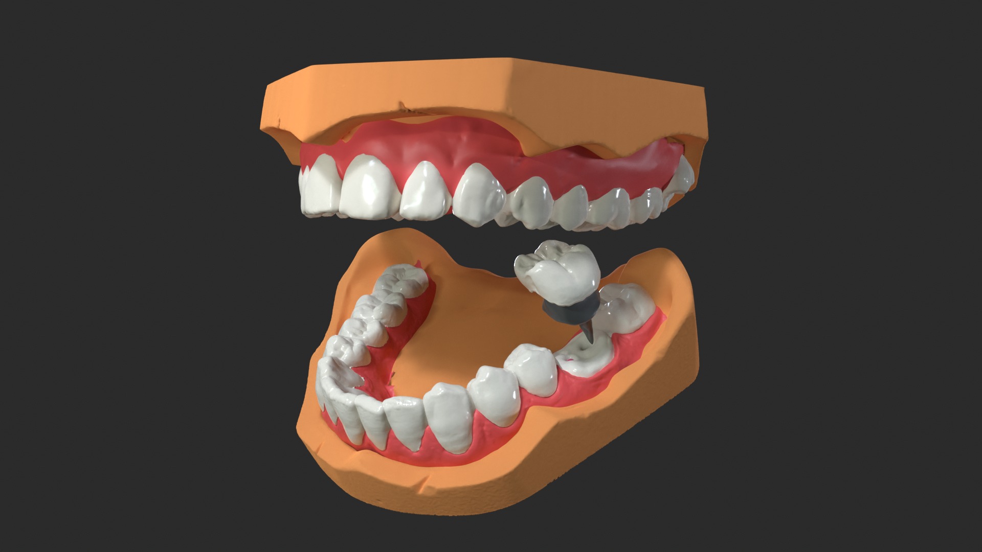 Human Dental Anatomy Mouth with Detached Crown and Inlay  3D print model_3