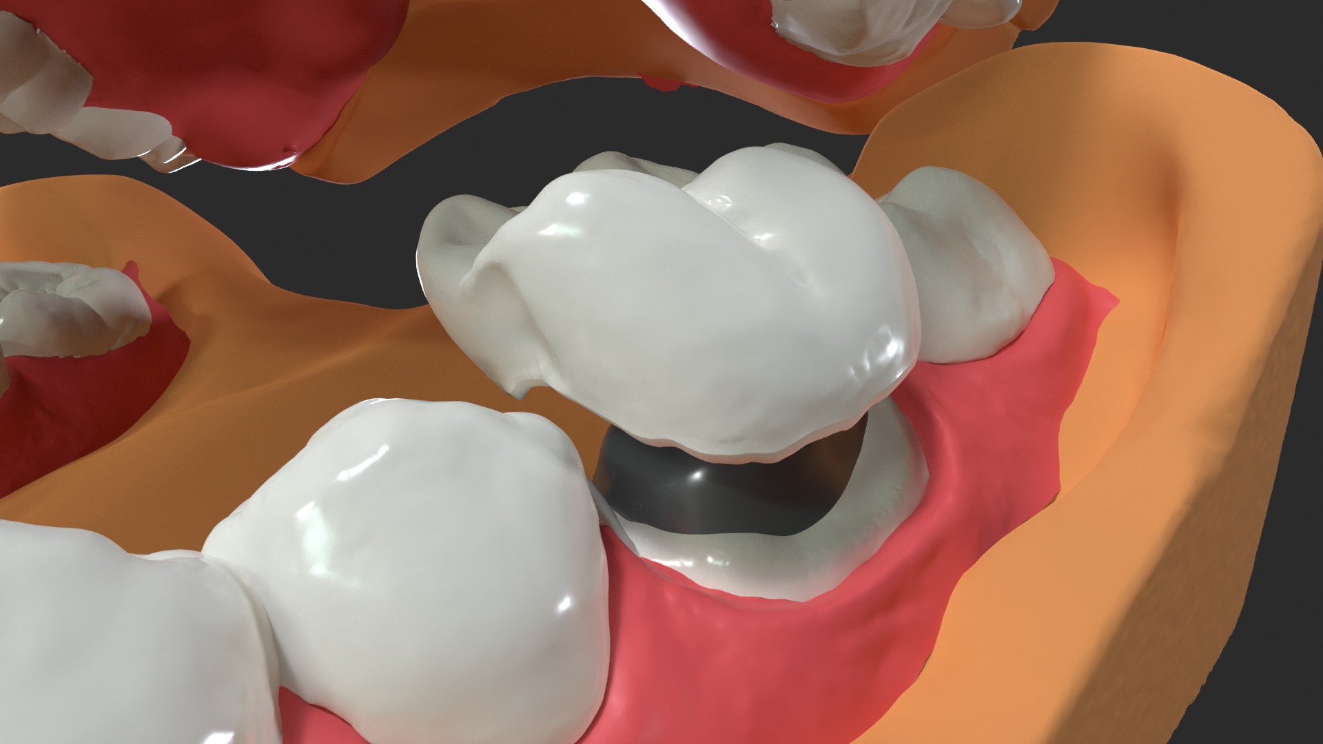 Human Dental Anatomy Mouth with Detached Crown and Inlay  3D print model_9